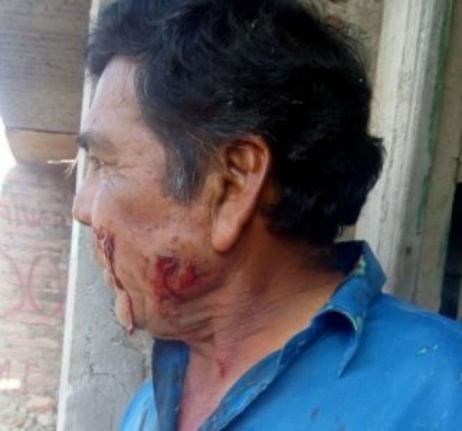 Vecino herido con balas de goma