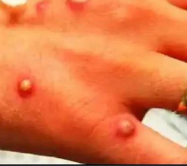 Tercer caso de viruela del mono en Argentina