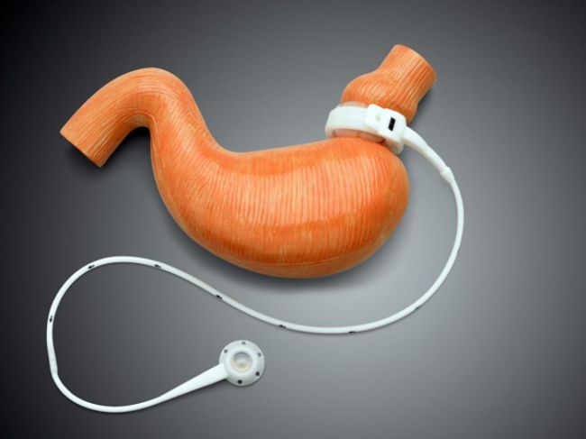 Primer Bypass gástrico en ámbito de salud pública